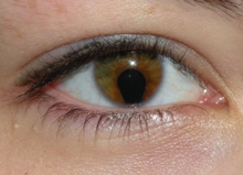 Eye Iris Defect 600X407