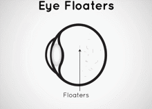 Eye Floaters (1)