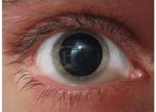 Pupil Large Dilated
