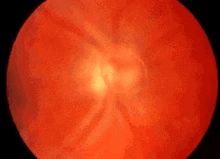 Seeing Spots In My Vision