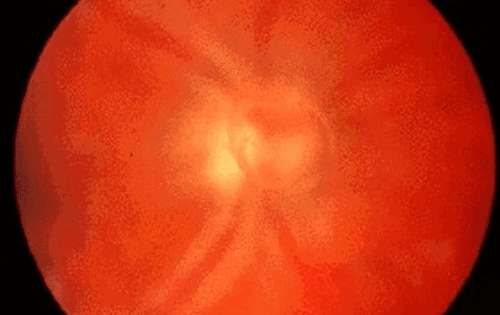Distorted Vision Look Like My Vision Appears To Be Distorted (Gradual Deterioration)