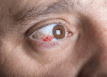 Red Spot On The White Part Of My Eye (1)