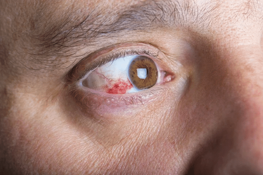 red spot on white eye