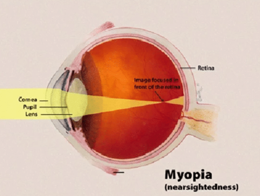 diagram of myopia