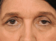 Droopy Eyelids