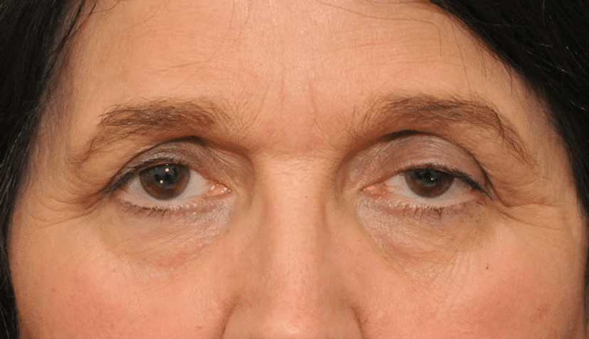 woman suffering from droopy eyelids
