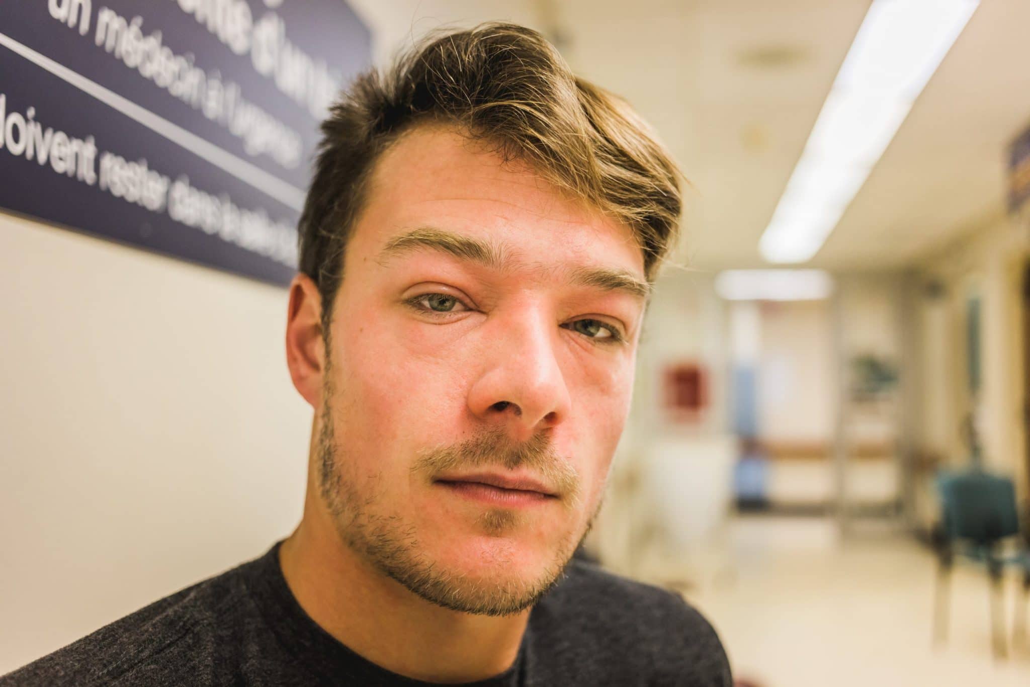 man suffering from swollen eyelids due to allergy