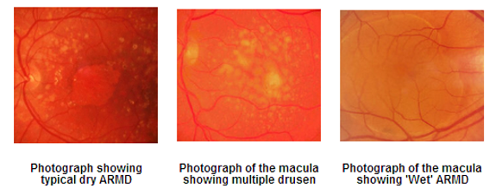 Diagram showing effects of macular degeneration