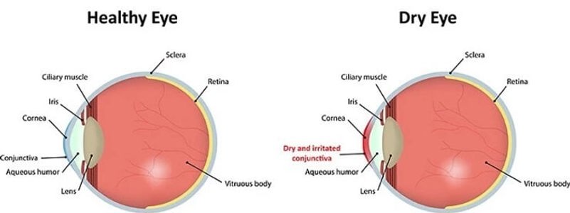Dry eye comparion with healthy eyes