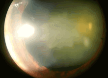 Surface Of My Eye Is Cloudy