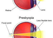 Squint To See Clearly