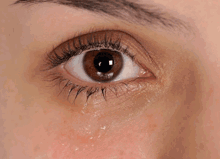 Eyes Get Watery When Seeing Bright Light