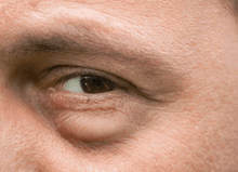 Eye Is Swelled Up Top 4 Causes