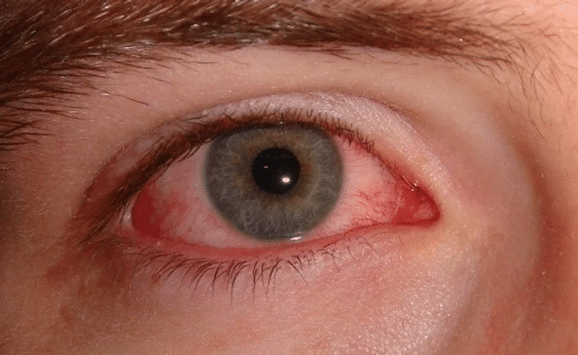 man suffering with bloodshot eyes