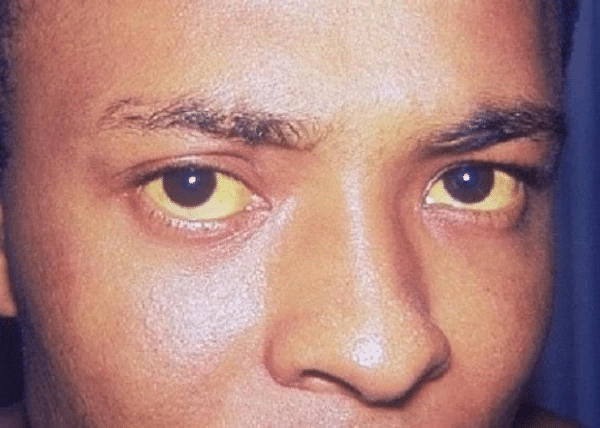 Bags Under Eyes  Symptoms Causes  Treatments