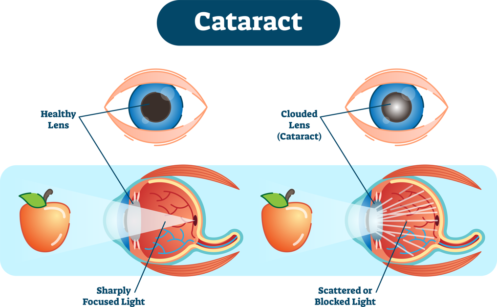 diagram showing how light affects cataract
