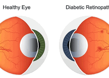 Opticians Can Indeed Detect Diabetes