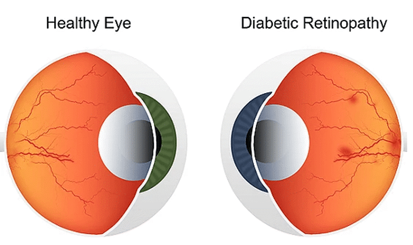 difference between a normal eye and diabetic eye