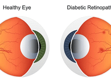 Opticians Can Indeed Detect Diabetes