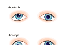 Why Do My Eyes Point In Different Directions