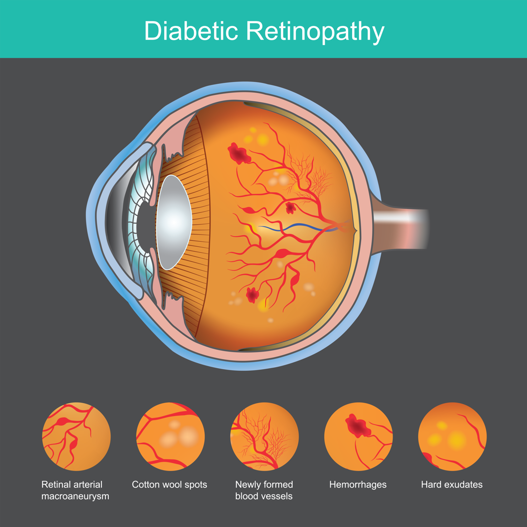 diagram of an eye showing diabetic retinopathy