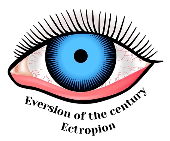 Diagram of eyelid turining outwards