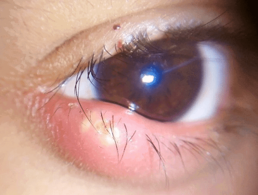 lump on eyelid