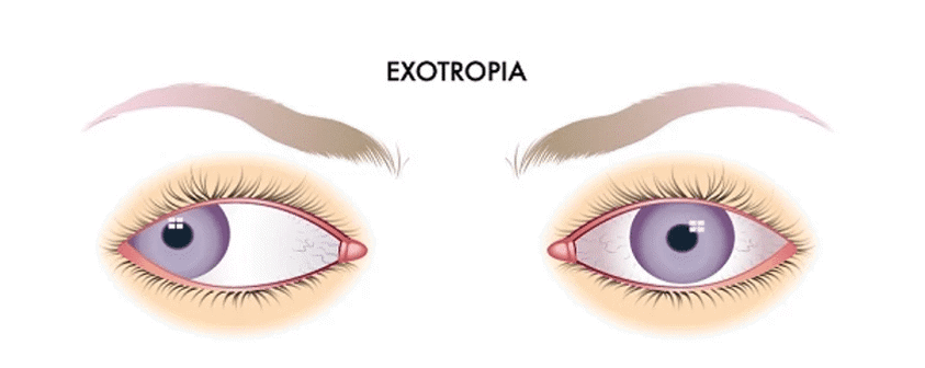walled eye - extoropia diagram