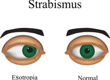 Lazy Eye