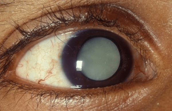 Arcus Senilis Arcus senelis is a white, light grey or blueish ring around  the edge of the cornea which is made up of fatty substances mostly... | By  The Eye Place NGFacebook