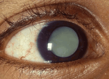 Bright Circle Surrounding White Light