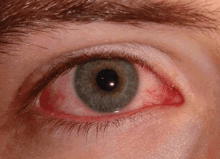 Red Eye Conjunctivitis