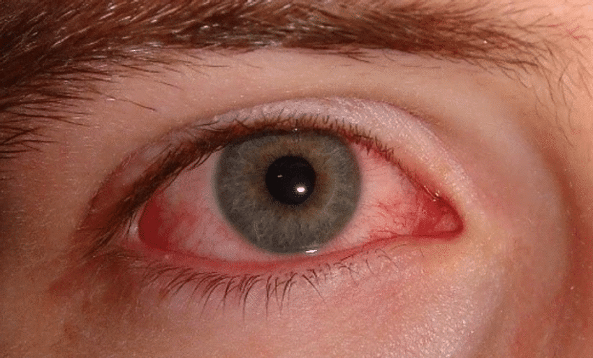 red eye conjunctivitis
