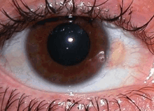 Yellow Spot On My Eye