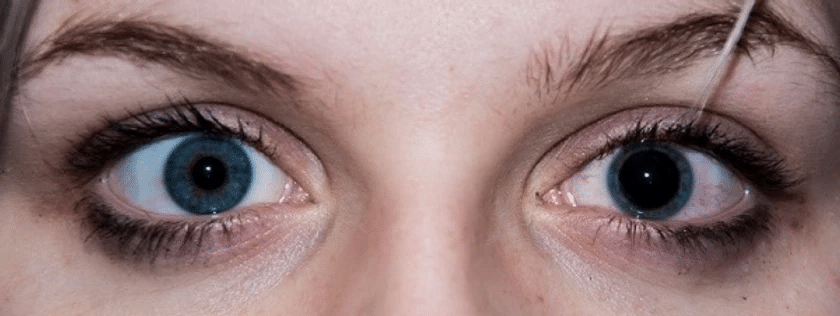pupils two different sizes pupils two different sizes