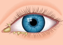 Discharge In My Eyes