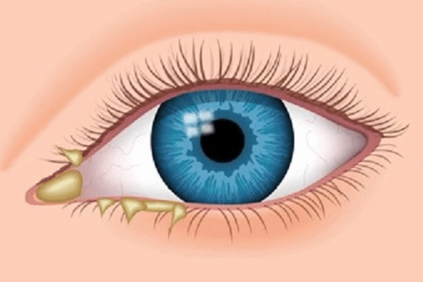 discharge coming out of an eye diagram