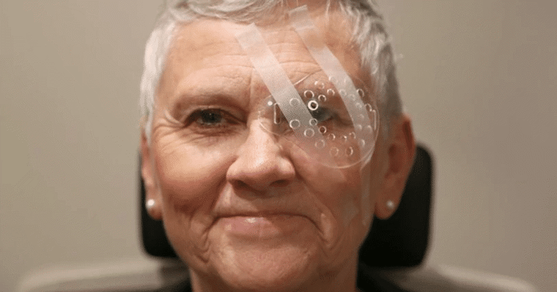 woman after cataract surgery