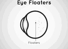 Eye Floaters (1)
