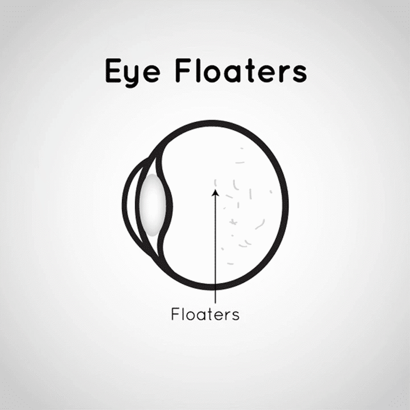 eye floater diagram