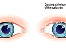 Particles In My Eyelashes