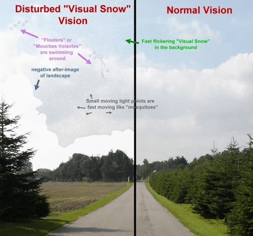 speck in my vision diagram
