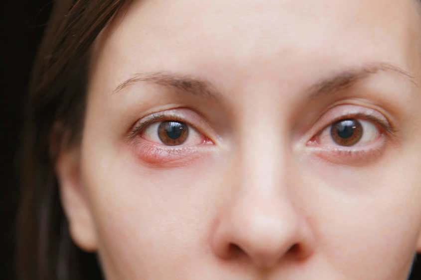 woman suffering from a bump on her eyelid