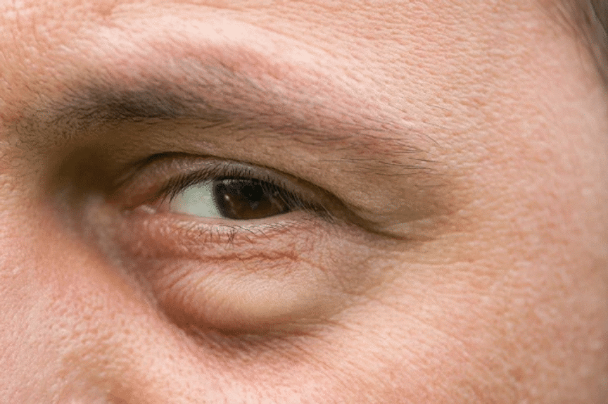 man suffering from eye bags