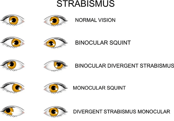 Eyes Appear Crossed Strabismus
