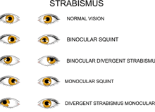 Eyes Appear Crossed Strabismus