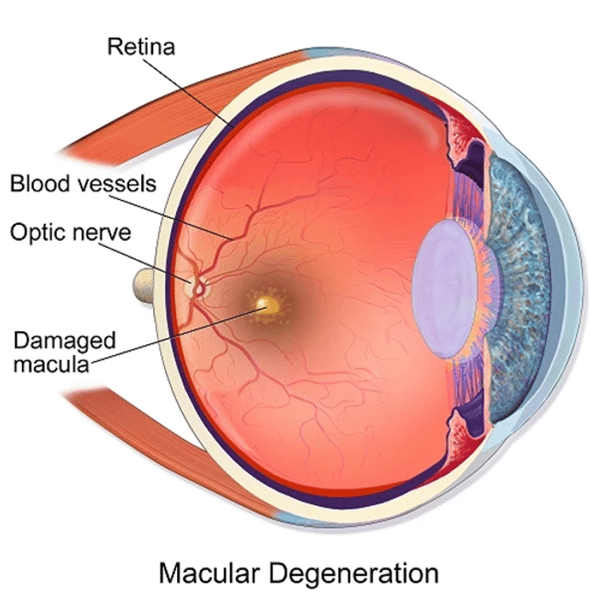 diagram of an eye showing macular degeneration