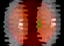 My Eye Appears To Be Bulging