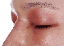 Eyelid Is Swelled Up