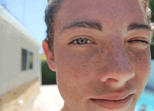 Brown Spot In My Eye